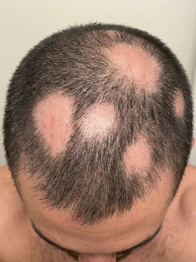 Antes do tratamento de alopecia androgenética