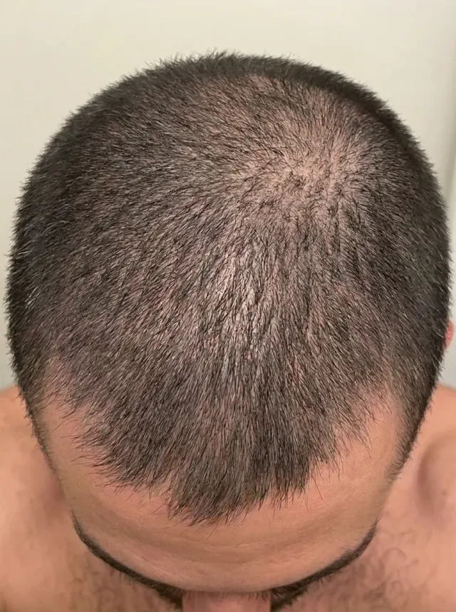 Alopecia androgenética