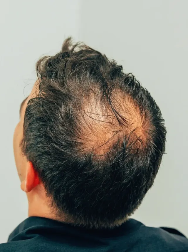 Antes do tratamento de calvície masculina