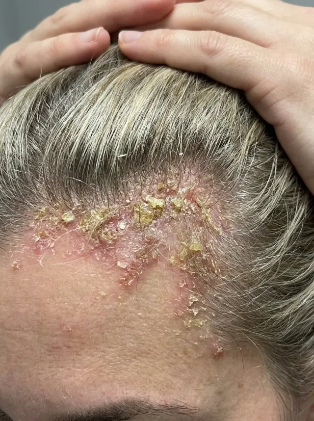 Antes do tratamento de dermatite seborreica e caspa