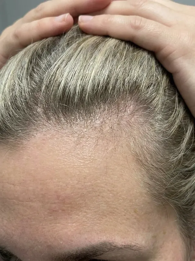 Dermatite seborreica e caspa