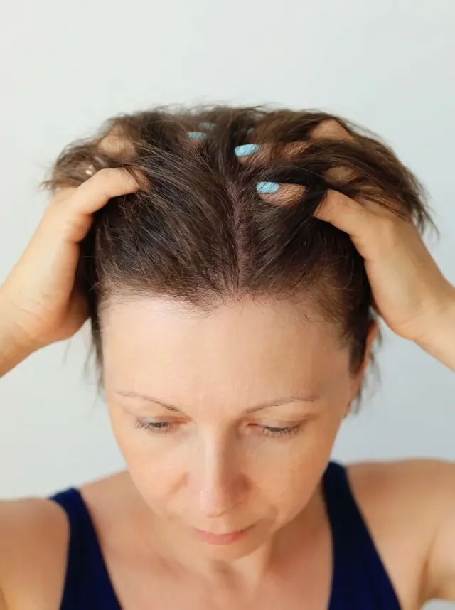 Antes do tratamento de queda de cabelo